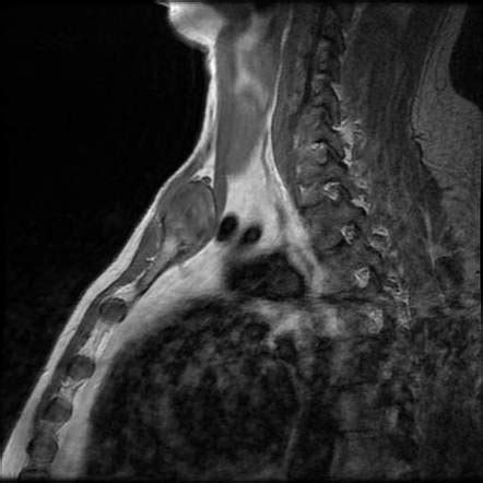Septic Arthritis Of Sternoclavicular Joint Image Radiopaedia Org