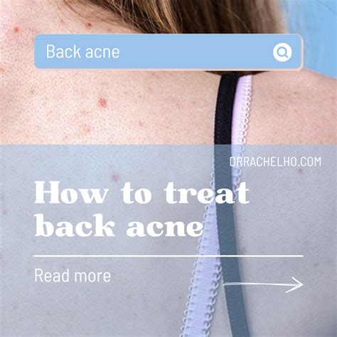 Dr Rachel Ho How To Treat Back Acne