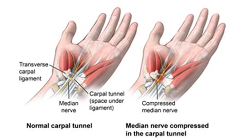 Carpal Tunnel Syndrome Johns Hopkins Medicine