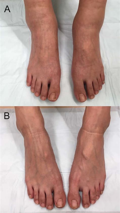 A Non Pitting Edema On Both Lower Limbs B Both Lower Limbs After