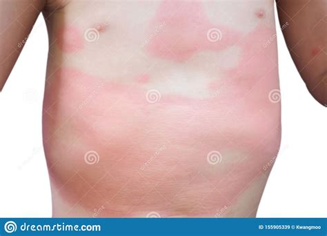 Severe Eczema Skin Rash And Allergic Reaction Symtom At Little Asian