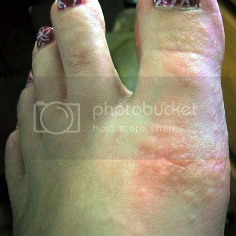 Dyshidrotic Eczema On Feet Pictures Photos