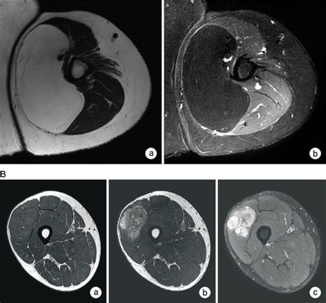 Magnetic Resonance Imagings Mris Of Lipoma A Liposarcoma B