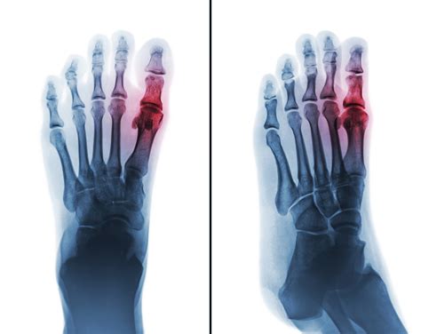 Arthritis Of The Big Toe — South West Foot Surgery