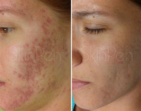 Professional Red Acne Scars Treatment Brisban Cutis Dermatology