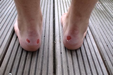 How To Avoid Getting Blisters On Your Feet