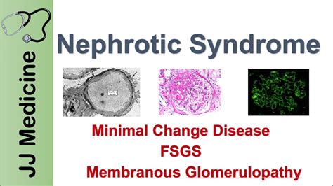 Nephrotic Syndrome Clinical Presentation Causes And Treatment Youtube