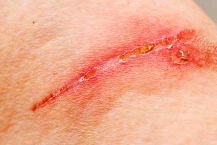 I used nair hair removal cream on my pubic area and i have aneixty too and im worrying that the chemicals in the cream might cause me problems mentaly? Exploring the Pros and Cons of Nair & Nads Hair Removal Cream