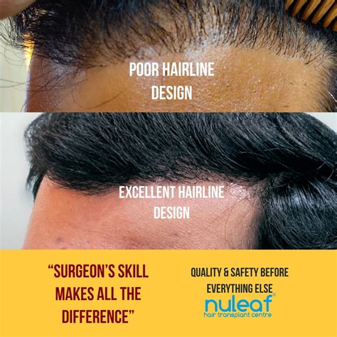 Average Cost Of Hair Transplant Home Design Ideas