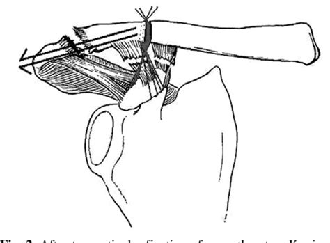 Figure 3 From Treatment Of Acromioclavicular Dislocation By Modified