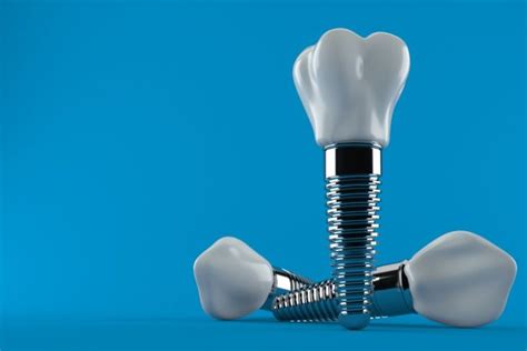 How Long Do Dental Implants Last Lifespan Of Dental Implants