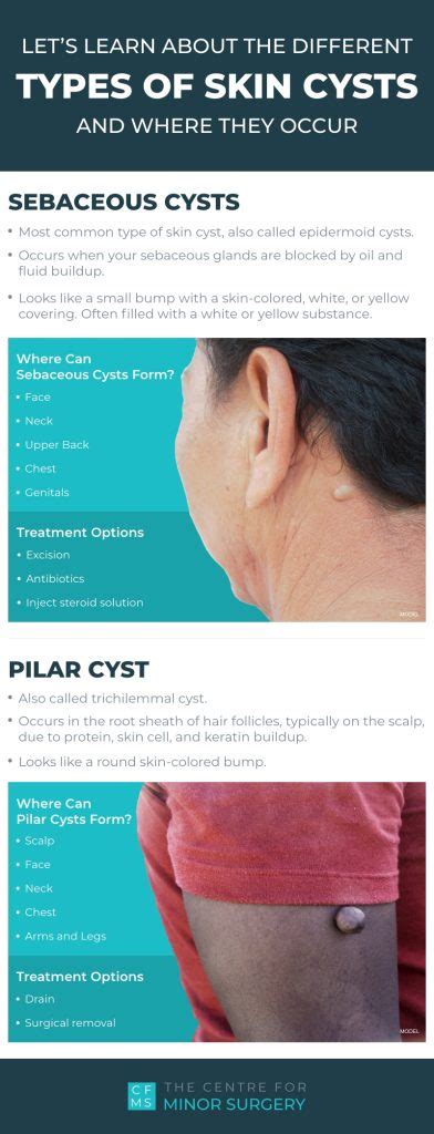 what are the different types of skin cysts and where do they occur infographic centre for