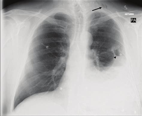 Chest X Ray Showing Left Sided Pleural Effusion With A Small Apical