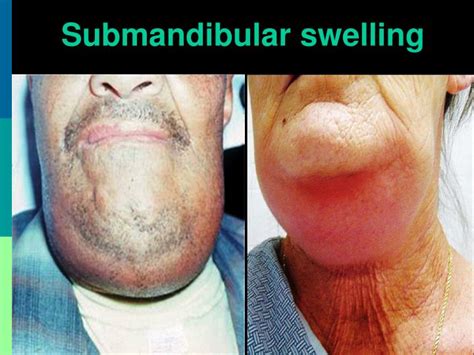 What Causes Submandibular Gland Swelling Images And Photos Finder