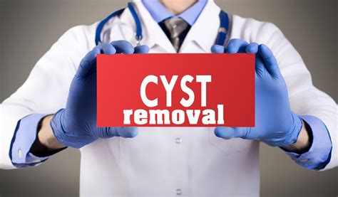 Cyst Removal Causes Diagnosis Treatment Options Pictures