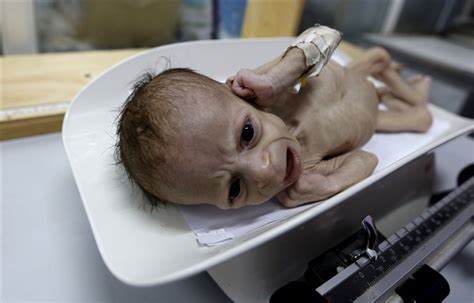 Horrifying Images Of Starving Children Of Yemen Photosimagesgallery