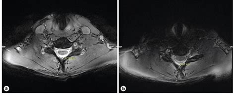 Mri Cervical Spine With Axial T2 Weighted Gradient Echo Images In A