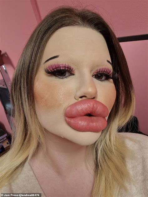 Woman Spent To Have The Biggest Lips On The World And Now