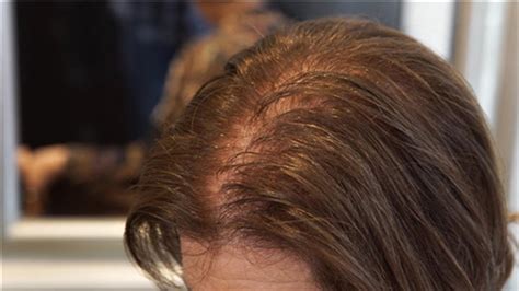 Jun 02, 2021 · thinning hair is also a problem women in their 50s have to deal with. As they age, women lose their hair, too ...