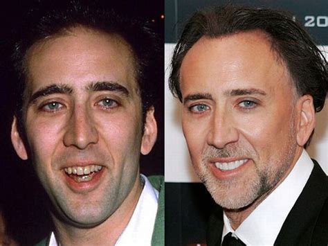 Celebrity Teeth Before After