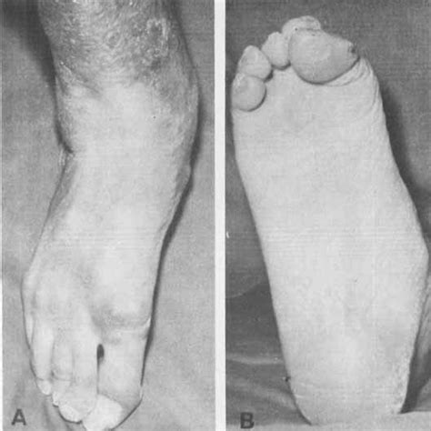 Hallux Tortus Plantar Callosities Are Present Under The Mediul Aspect