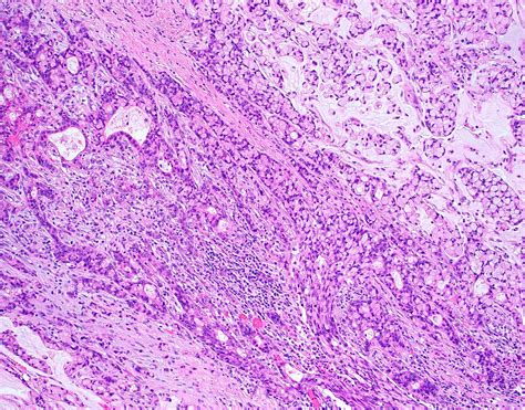 Pathology Outlines Goblet Cell Adenocarcinoma