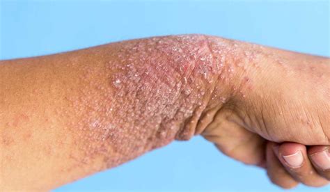 Más De 12 Millones De Personas Padecen Dermatitis Atópica Yucatan Ahora