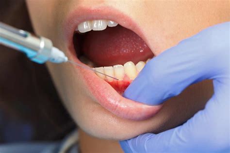 Znieczulenie zęba jak działa co zawiera i kiedy warto skorzystać