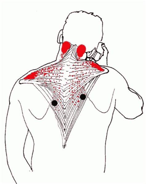 What Are The Causes Of Trapezius Muscle Pain