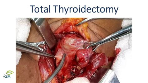 Total Thyroidectomy Thyroid Cancer Operative Surgery YouTube