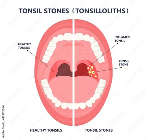 Tonsil Stones Crypts Viral Virus Gland Strep Throat Sore Enlarged Lymph
