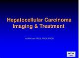Pictures of Hcc Hepatocellular Carcinoma Treatment
