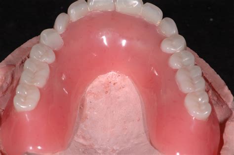 Duraflex Partial Denture Cost Cosmetic Flexible Dentures Loughton