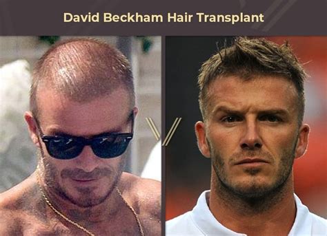 David Beckhams Hair Transplant Before And After Transformation