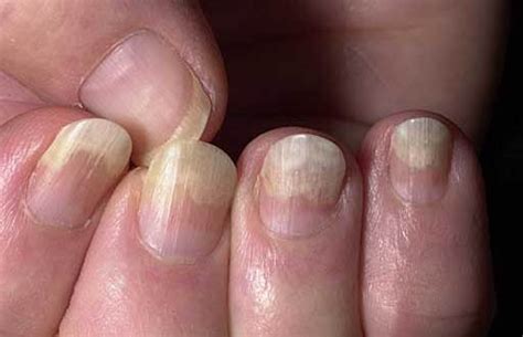 What Is Nail Psoriasistreatmentcauses And Prevention