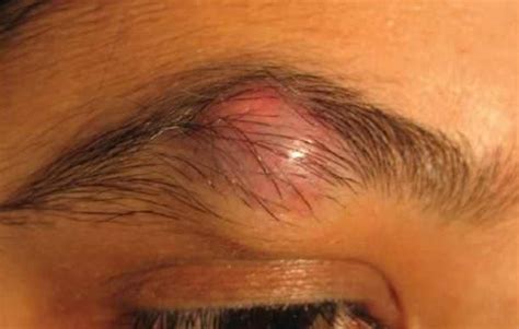 Awesome Ingrown Hair Eyebrow Swollen And Description In 2020 Ingrown