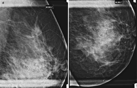Fig 132 Multicentric Invasive Ductal Carcinoma Iii Diseases Of The Chest Breast