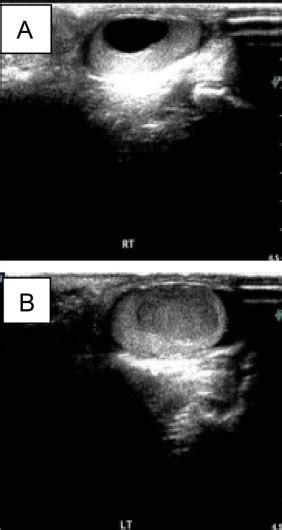 Testicular Yolk Sac Tumor And Mature Teratoma Synchronous Bilateral