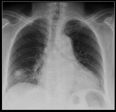 A Chest Radiograph Showing A Large Pn At The Right Lung Open I
