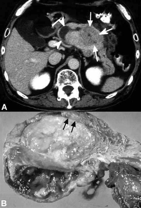 Glucagonoma Presenting With Pancreatitis And A Pseudocyst Like Lesion