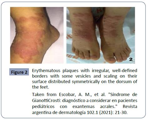 Gianotti Crosti Syndrome And Its Relationship With Acral Rash Pe