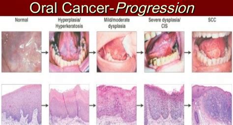 the warning signs and symptoms of mouth cancer emergency dentist brooklyn ny