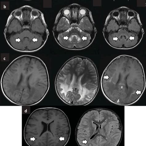 The Classification Of Heritable Disorders With White Matter