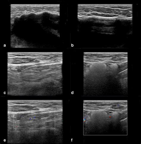 Ultrasound Of Bilateral Breasts A Anechoic Area With Echogenic Wall