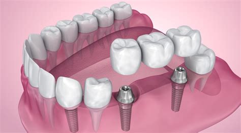 Propiedades Del Titanio En Implantes Dentales Estudi Dental Barcelona
