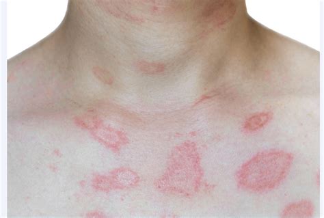 8 Plaque Psoriasis Terms You Need To Know Healthandconditons