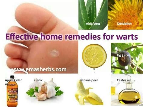 Pin By Barbara Roletter On Home Remedies Home Remedies For Warts Dry