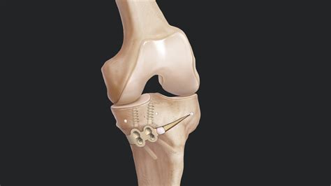 Arthrex Hto Using The Ibalance® Osteotomy System