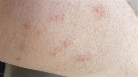 Had This Rash Over Both Upper Legs At A Place I Lived A Couple Of Years