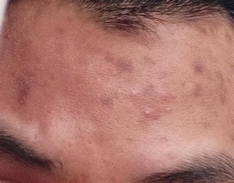 Skin Concerns Need Help This Is My Forehead As You Can See Ive